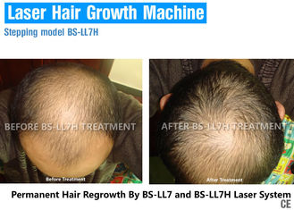 Low Level Laser Therapy For Hair Growth